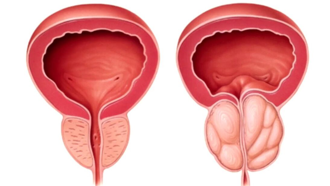 gesunde und kranke Prostata