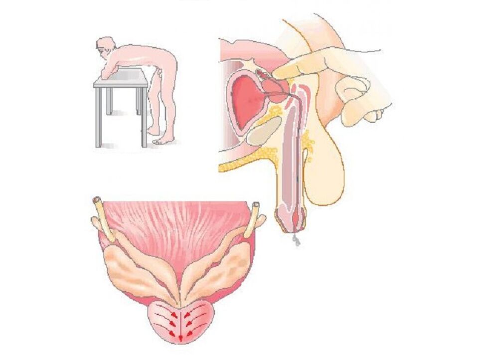 Prostata-Massagetechnik, die von einem Arzt durchgeführt wird, um eine Analyse des Sekrets durchzuführen. 